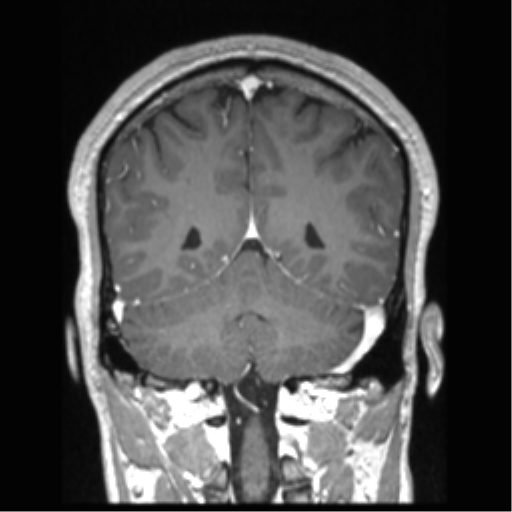 Cerebral arteriovenous malformation (Radiopaedia 39259-41506 Coronal T1 C+ 31).png