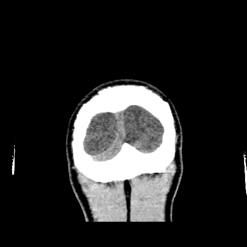 Cerebral arteriovenous malformation (Radiopaedia 61964-70028 Coronal non-contrast 58).jpg