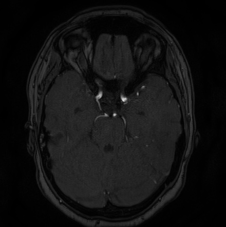 Cerebral arteriovenous malformation (Radiopaedia 74411-85654 Axial MRA 39).jpg