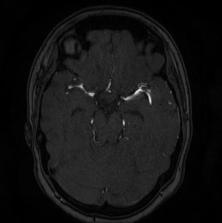 Cerebral arteriovenous malformation (Radiopaedia 74411-85654 Axial MRA 47).jpg