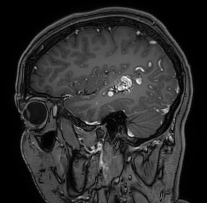 Cerebral arteriovenous malformation (Radiopaedia 74411-85654 Sagittal T1 C+ 28).jpg