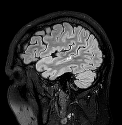 Cerebral arteriovenous malformation (Radiopaedia 74411-85746 Sagittal FLAIR 18).jpg