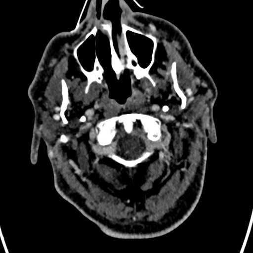 Cerebral arteriovenous malformation (Radiopaedia 78188-90746 Axial C+ delayed 6).jpg