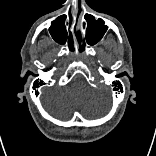 Cerebral arteriovenous malformation (Radiopaedia 78188-90746 Axial non-contrast 28).jpg