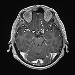 Cerebral arteriovenous malformation (Radiopaedia 84015-99245 Axial T1 C+ 62).jpg