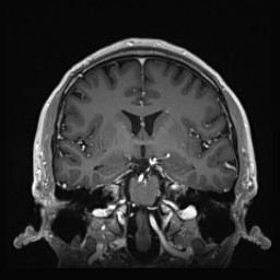 Cerebral arteriovenous malformation (Radiopaedia 84015-99245 Coronal T1 C+ 76).jpg