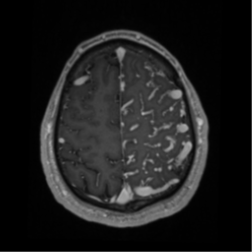 Cerebral arteriovenous malformation - huge (Radiopaedia 35734-37272 Axial T1 C+ 60).png