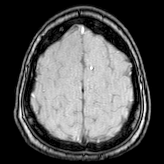 Cerebral arteriovenous malformation at posterior body of corpus callosum (Radiopaedia 74111-84925 Axial MRA 191).jpg