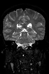 Cerebral arteriovenous malformation at posterior body of corpus callosum (Radiopaedia 74111-84925 Coronal T2 108).jpg