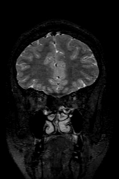 Cerebral arteriovenous malformation at posterior body of corpus callosum (Radiopaedia 74111-84925 Coronal T2 37).jpg