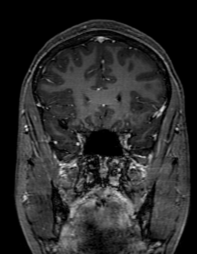 Cerebral arteriovenous malformation at posterior body of corpus callosum (Radiopaedia 74111-84925 K 107).jpg