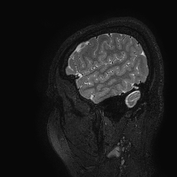 Cerebral arteriovenous malformation at posterior body of corpus callosum (Radiopaedia 74111-84925 Sagittal T2 9).jpg