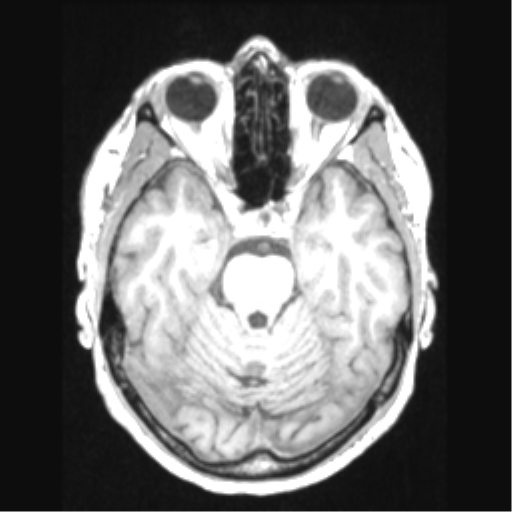 File:Cerebral arteriovenous malformation with hemorrhage (Radiopaedia 34422-35737 Axial T1 27).png