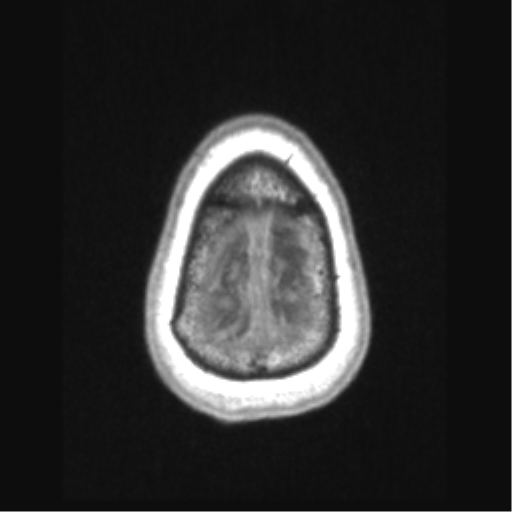 File:Cerebral arteriovenous malformation with hemorrhage (Radiopaedia 34422-35737 Axial T1 72).png