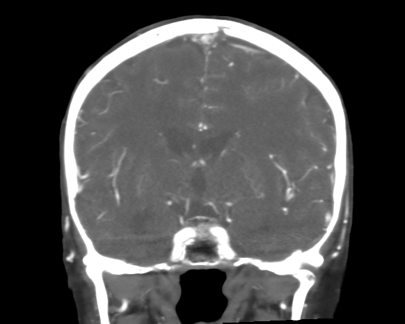 Cerebral arteriovenous malformation with lobar hemorrhage (Radiopaedia 44725-48511 A 29).png