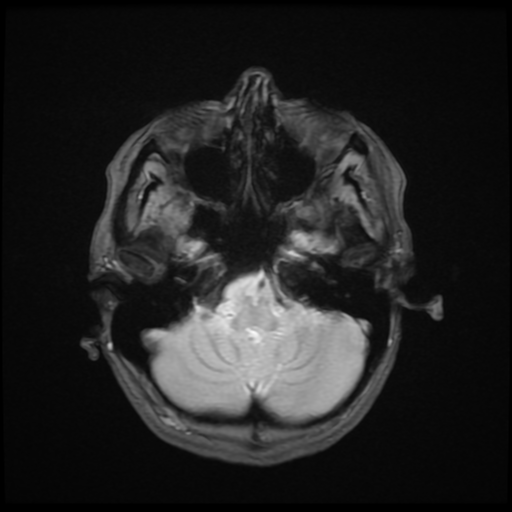 File:Cerebral autosomal dominant arteriopathy with subcortical infarcts and leukoencephalopathy (CADASIL) (Radiopaedia 41018-43768 Ax 2D MERGE 4).png