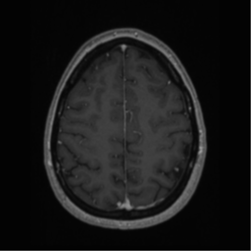File:Cerebral cavernoma and development venous anomaly (Radiopaedia 37603-39482 Axial T1 C+ 58).png