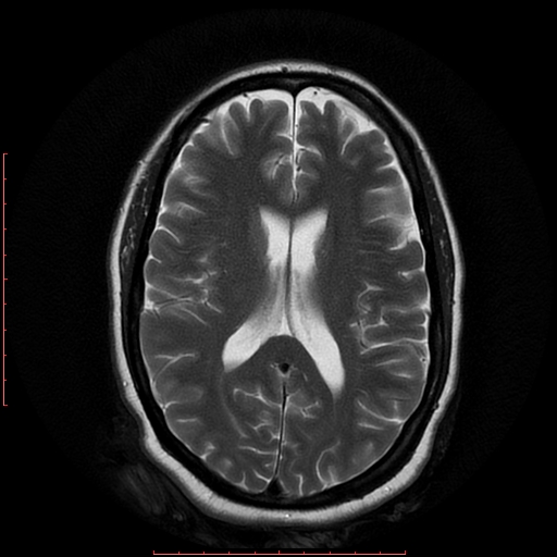 File:Cerebral cavernous malformation (Radiopaedia 26177-26306 Axial T2 13).jpg