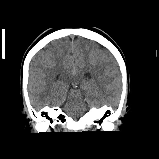 Cerebral cavernous venous malformation (Radiopaedia 70008-80022 non-contrast 43).jpg