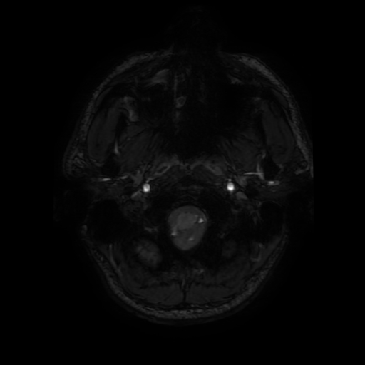 Cerebral cavernous venous malformation (Zabramski type II) (Radiopaedia 85511-101198 Axial SWI 11).jpg