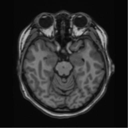 File:Cerebral cavernous venous malformations (Radiopaedia 48117-52946 Axial T1 9).png