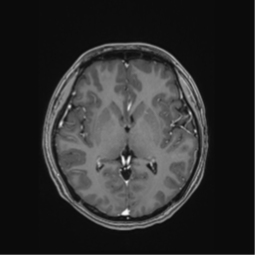 Cerebral cavernous venous malformations (Radiopaedia 48117-52946 Axial T1 C+ 30).png