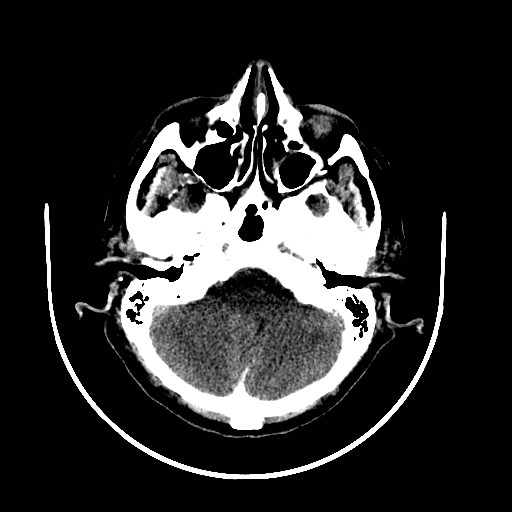 Cerebral edema (evolution in time) (Radiopaedia 19418-19439 non-contrast 20).jpg