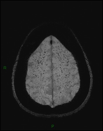 Cerebral fat embolism (Radiopaedia 35022-36525 Axial SWI 50).jpg