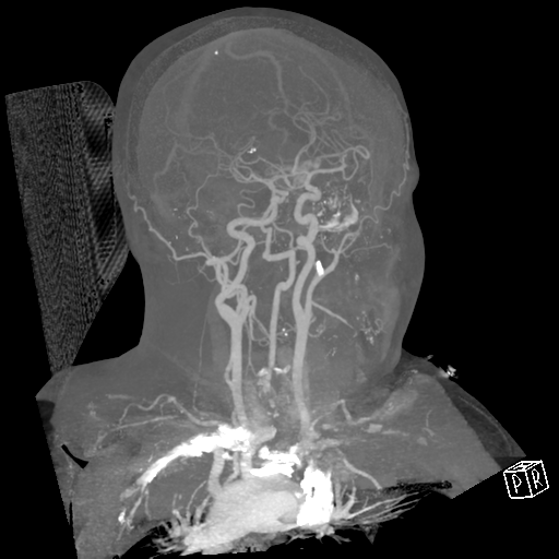 File:Cerebral hemorrhage secondary to arteriovenous malformation (Radiopaedia 33497-34571 A 34).png