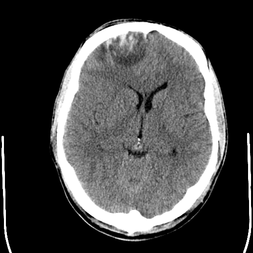 File:Cerebral hemorrhagic contusions- temporal evolution (Radiopaedia 40224-42754 Axial non-contrast 13).png