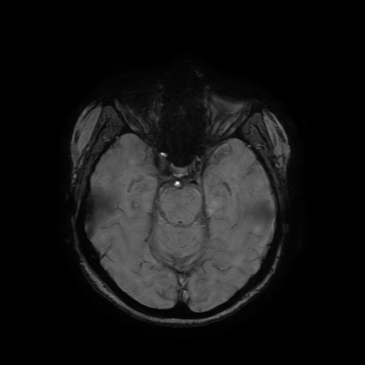 File:Cerebral metastases - melanoma (Radiopaedia 80972-94522 Axial SWI 36).jpg
