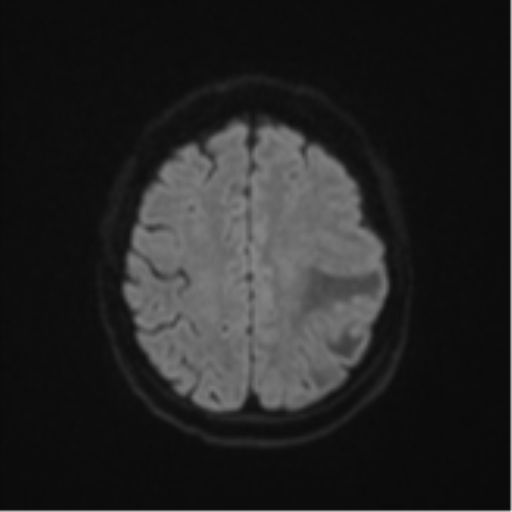 File:Cerebral metastasis (Radiopaedia 46744-51248 Axial DWI 49).png