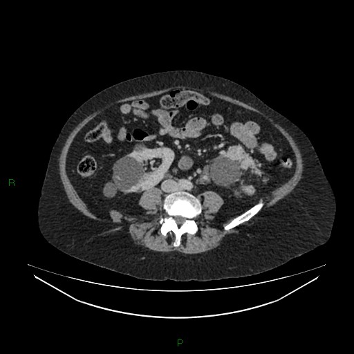 File:Cerebral metastasis from renal cell carcinoma (Radiopaedia 82306-96378 A 108).jpg