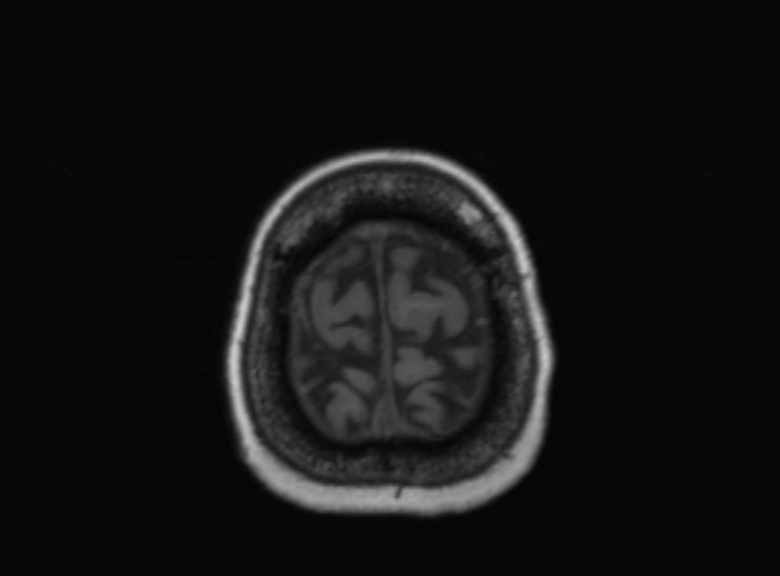 Cerebral ring enhancing lesions - cerebral metastases (Radiopaedia 44922-48817 Axial T1 114).jpg