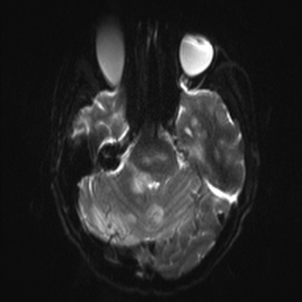Cerebral toxoplasmosis (Radiopaedia 53993-60132 Axial DWI 8).jpg