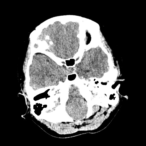 Cerebral tuberculosis with dural sinus invasion (Radiopaedia 60353-68018 Axial non-contrast 10).jpg