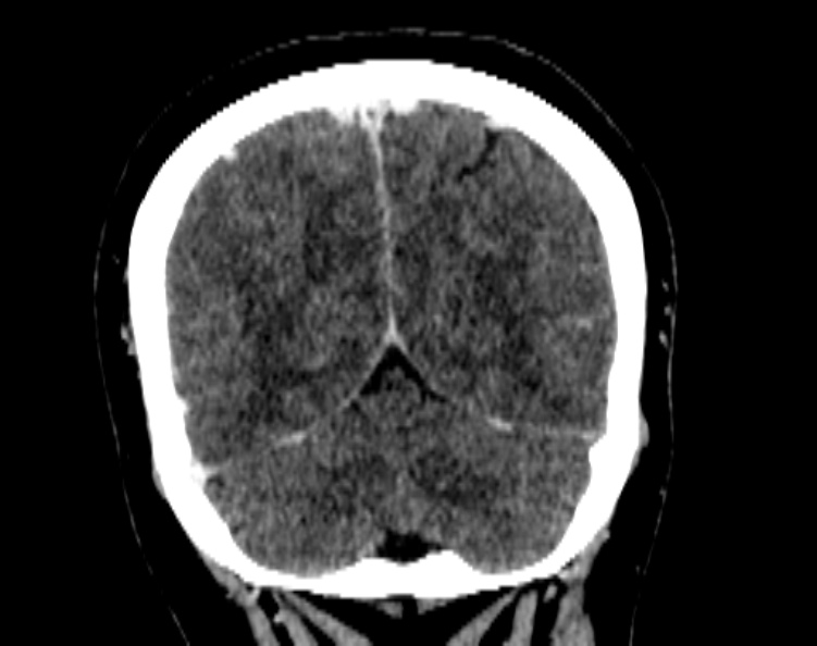 Cerebral venous hemorrhagic infarct from venous sinus thrombosis (Radiopaedia 55433-61883 Coronal C+ delayed 48).jpg