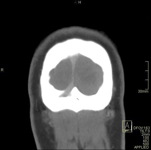 Cerebral venous sinus thrombosis (Radiopaedia 91329-108965 Coronal venogram 84).jpg