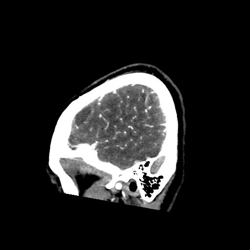 File:Cerebral venous throbmosis - hemorrhagic venous infarction (Radiopaedia 87318-103613 Sagittal CT venogram 3).jpg