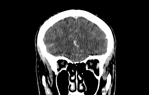 File:Cerebral venous thrombosis (CVT) (Radiopaedia 77524-89685 C 14).jpg