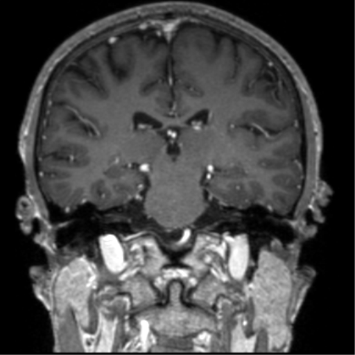 Cerebral venous thrombosis (Radiopaedia 38392-40469 Coronal T1 C+ 39).png