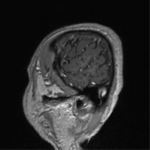 File:Cerebral venous thrombosis (Radiopaedia 38392-40469 Sagittal T1 C+ 78).png
