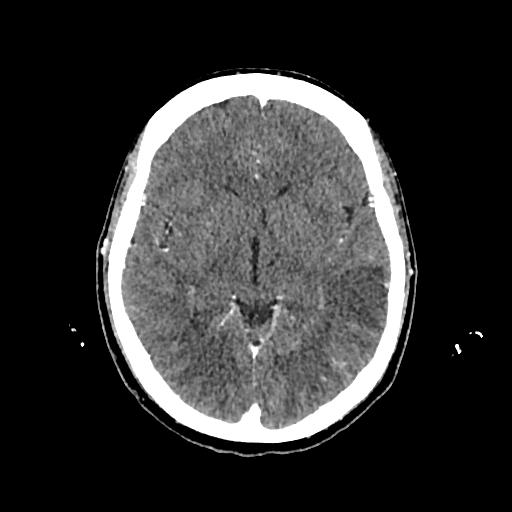 File:Cerebral venous thrombosis with venous hemorrhagic infarct (Radiopaedia 90354-107660 Axial with contrast 80).jpg