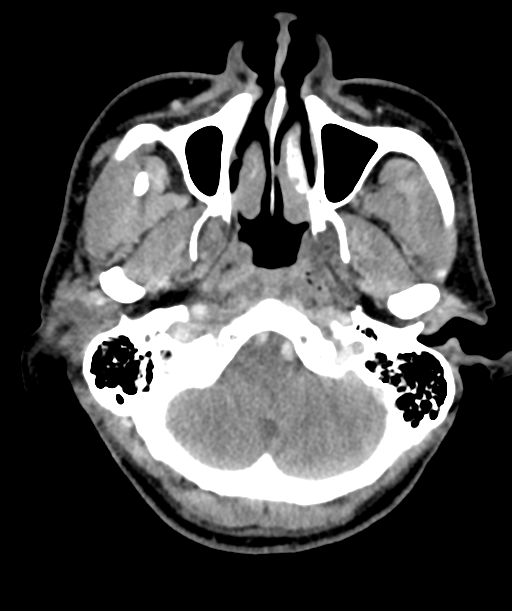 Cervical abscess (Radiopaedia 43725-47184 A 8).png