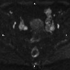 File:Cervical adenocarcinoma (Radiopaedia 65011-73985 Axial DWI 53).jpg
