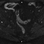Cervical adenocarcinoma (Radiopaedia 65011-73985 Axial DWI 65).jpg