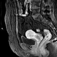 File:Cervical adenocarcinoma (Radiopaedia 65011-73985 E 18).jpg