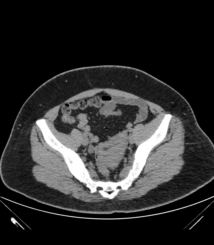 Cervical aortic arch with coarctation and aneurysms (Radiopaedia 44035-47552 Axial non-contrast 84).jpg