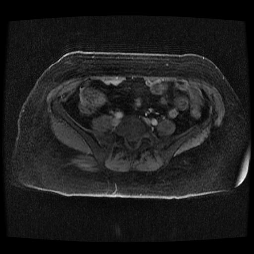 File:Cervical carcinoma (Radiopaedia 70924-81132 Axial T1 C+ fat sat 257).jpg