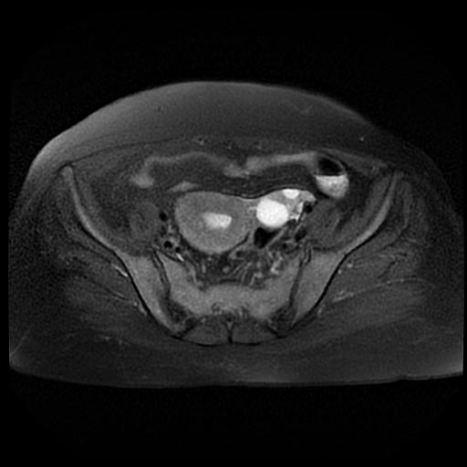 File:Cervical carcinoma (Radiopaedia 88010-104555 Axial T2 fat sat 6).jpg